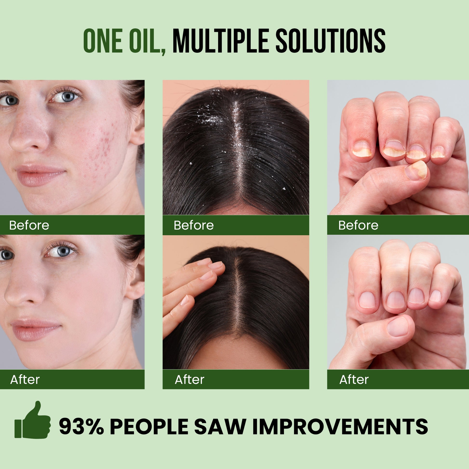Opure Tea Tree Oil – 100% Pure Premium Essential Oil for Hair, Skin & Nails (30ML)