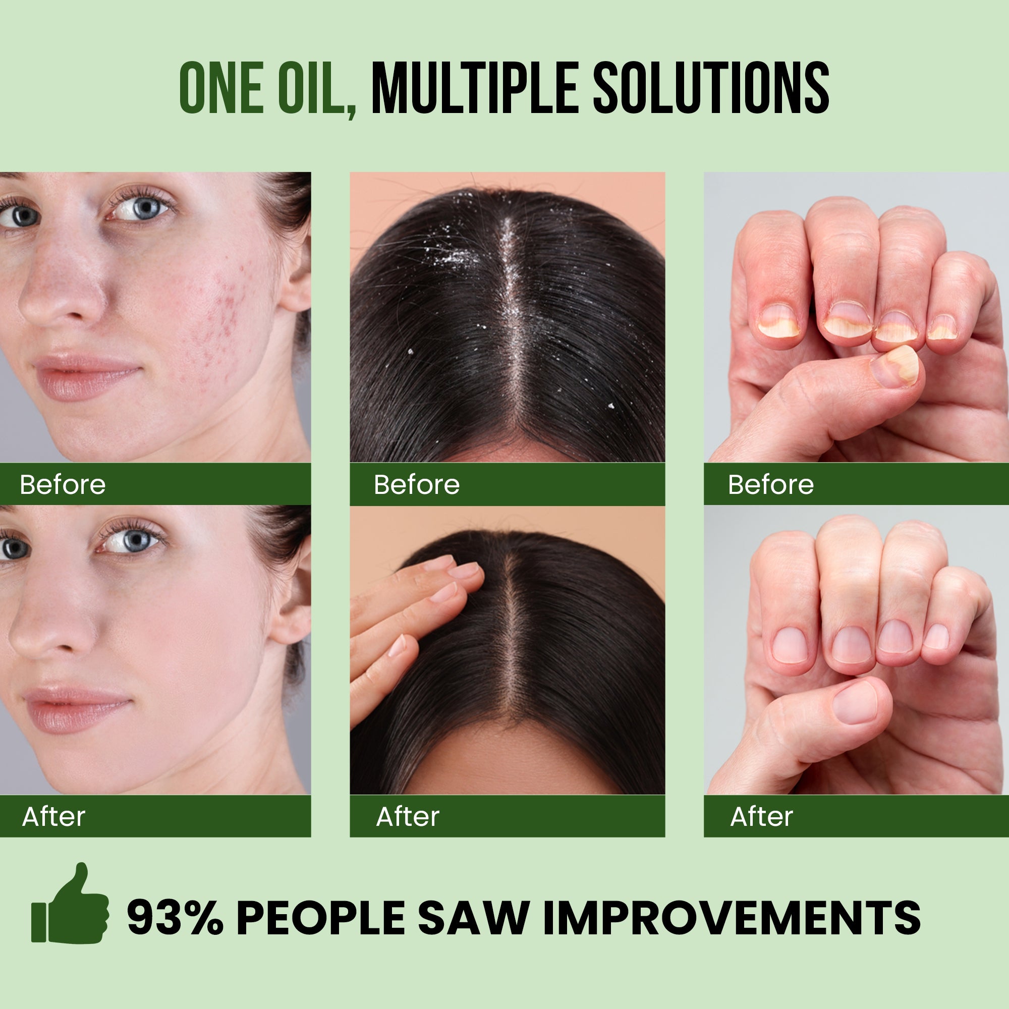 Opure Tea Tree Oil – 100% Pure Premium Essential Oil for Hair, Skin & Nails (30ML)